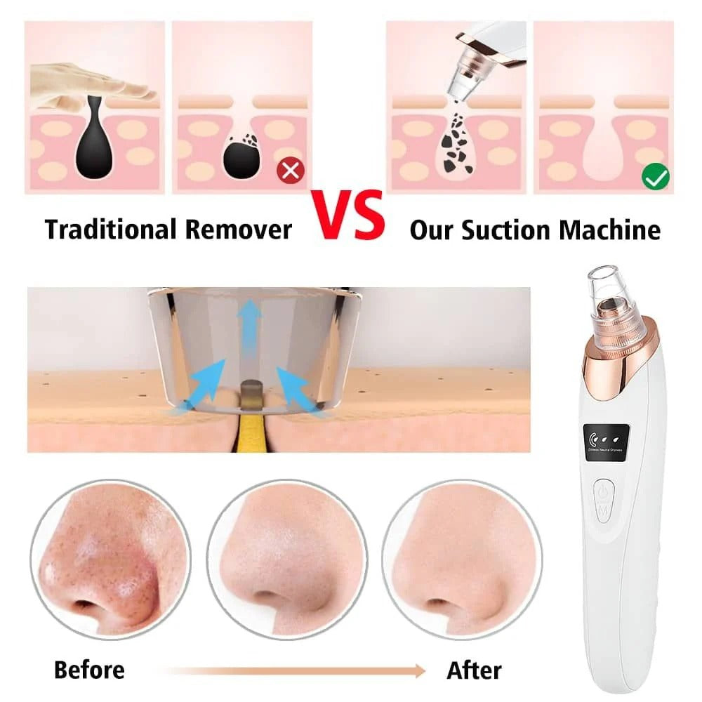 Havenly™ Professional Electric Blackhead Remover | 5-in-1 Vacuum Pore Cleaner & Acne Suction Machine | USB Rechargeable Skin Exfoliating Tool - HAVENLY
